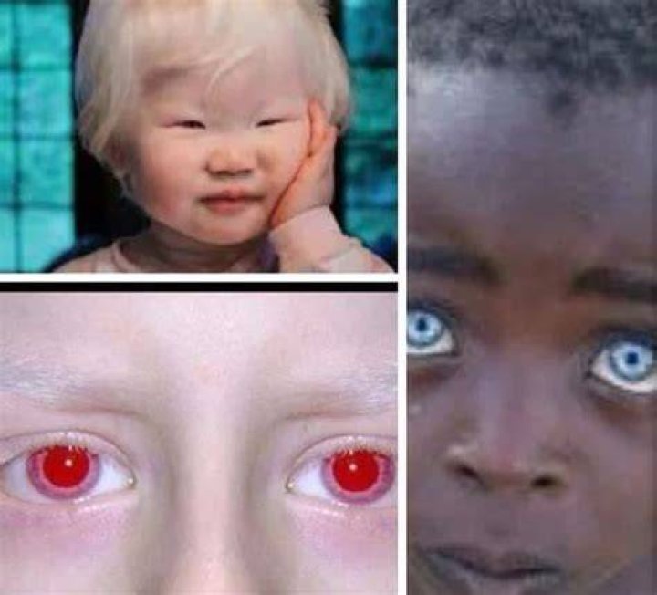 Can albinos see color?