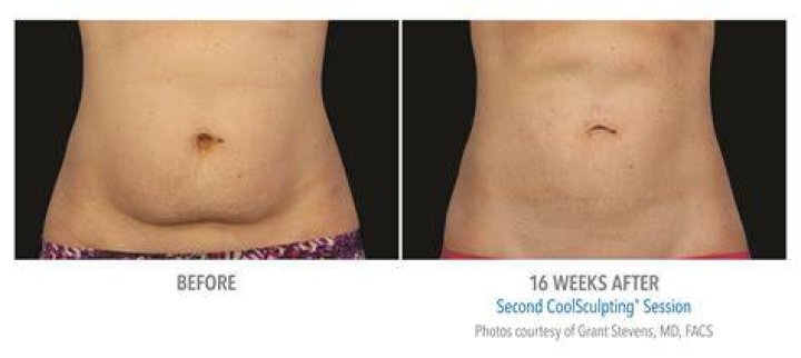 Can CoolSculpting give you a six pack?
