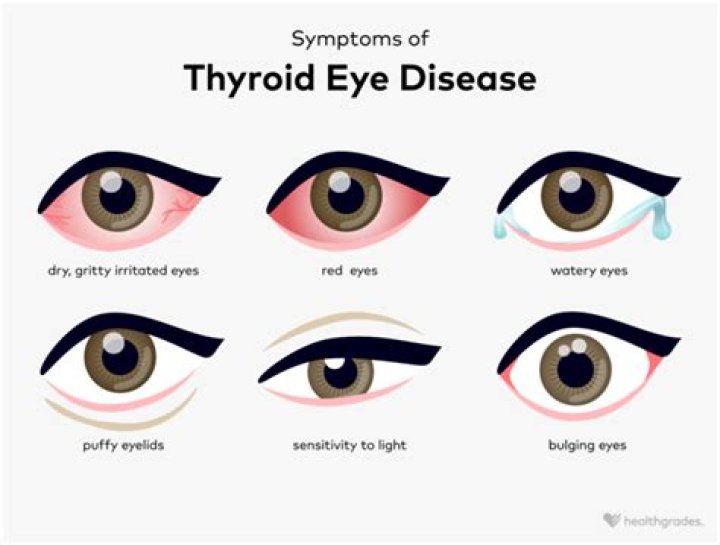Can hypothyroidism affect eyesight?