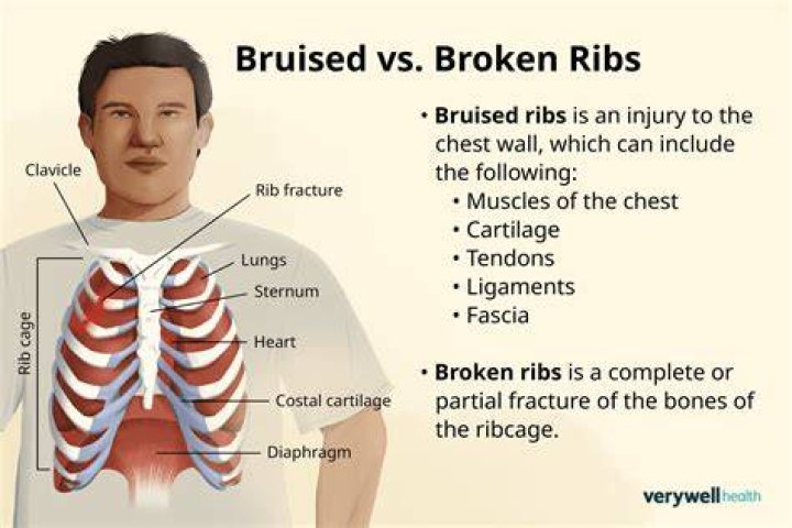 Can I play sports with bruised ribs?