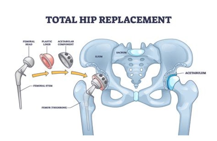 Can you have a second hip replacement?
