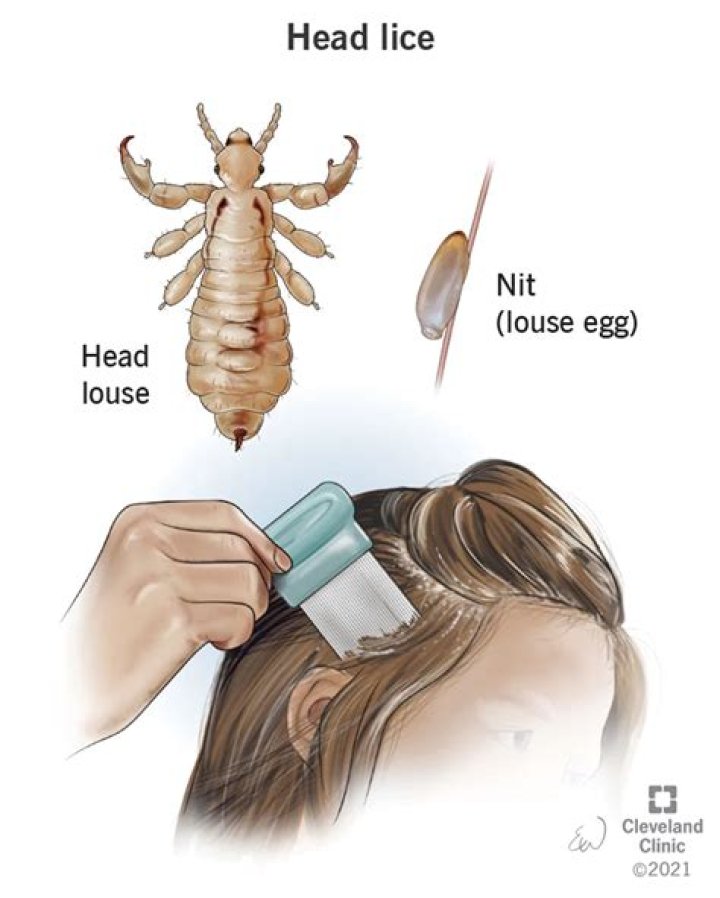 Do lice go in your ears?