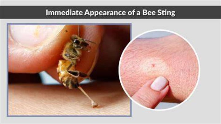 Does deodorant help a bee sting?