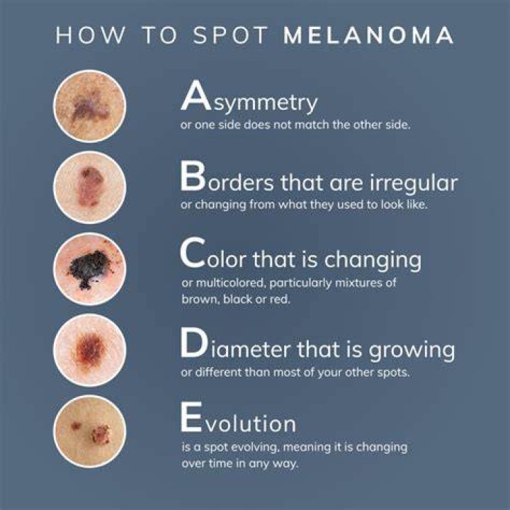 Does melanoma flake off?