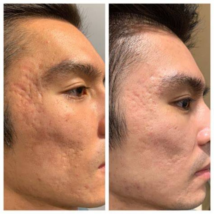 Does microneedling help with ice pick scars?