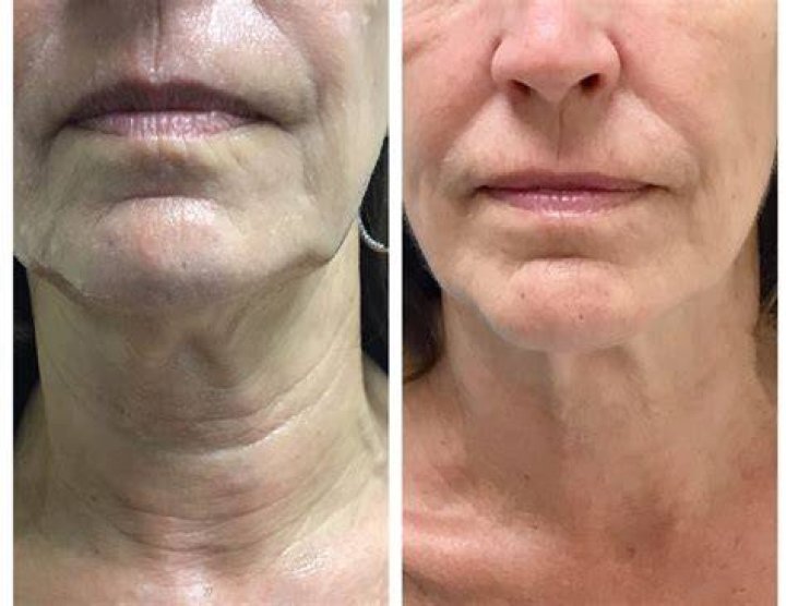 Does microneedling work for turkey neck?