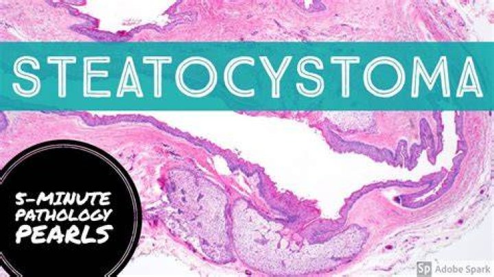 How do I know if I have steatocystoma?