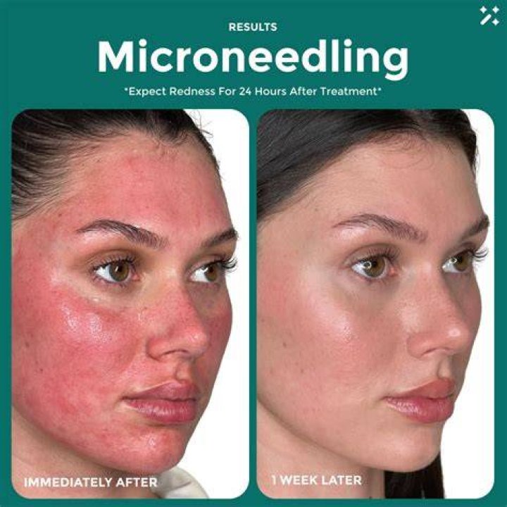 How long after microneedling can I get a facial?