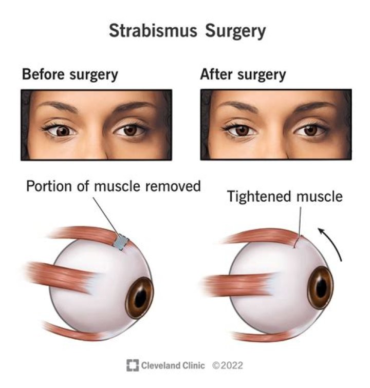 How long is recovery from strabismus surgery?