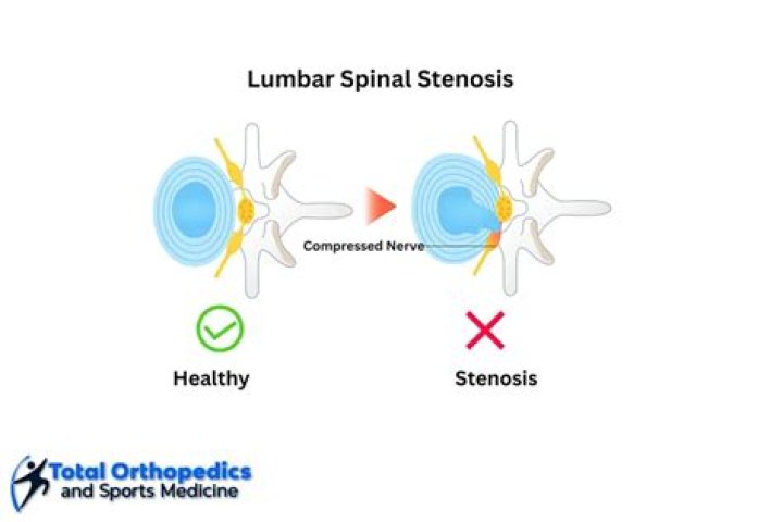 Is stenosis a disability?