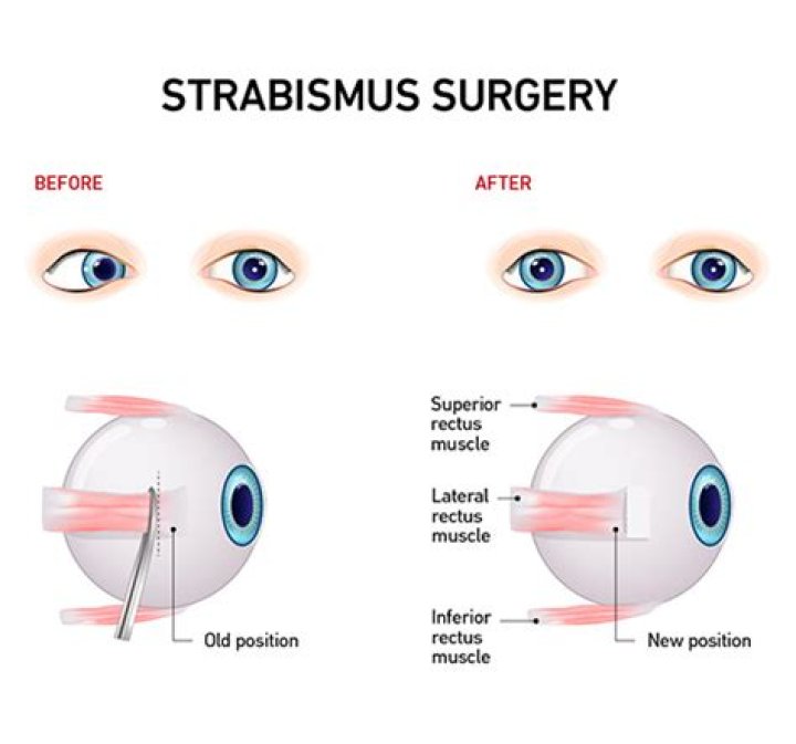 Is strabismus surgery safe for kids?