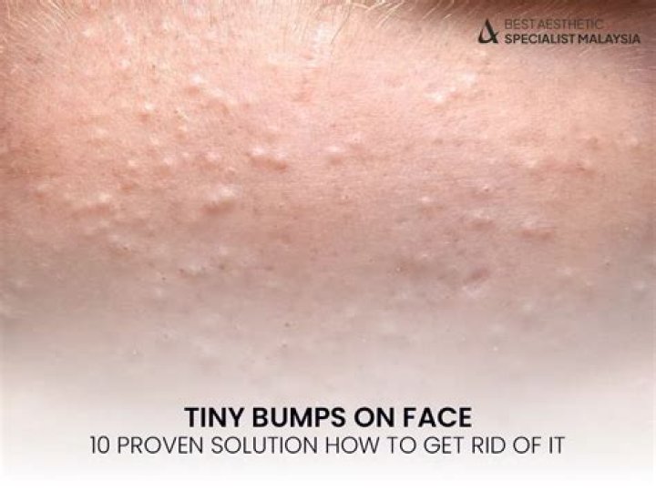 What are small bumps on face?