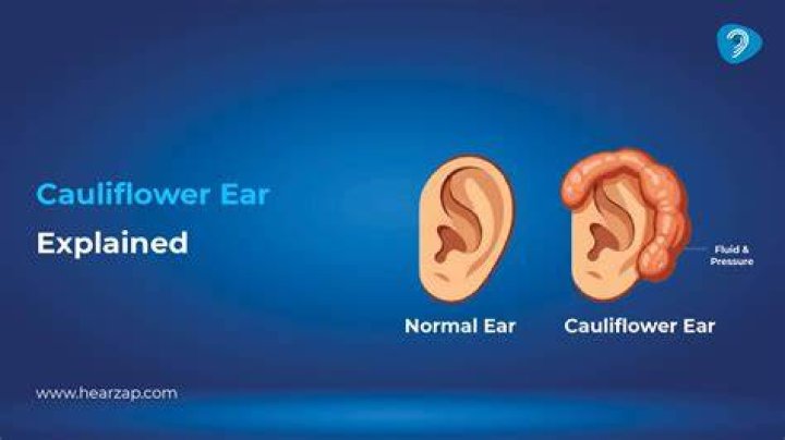 What happens if you pop cauliflower ear?