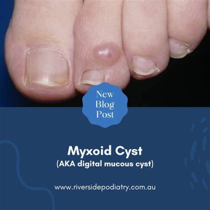 What is a myxoid cyst on toe?