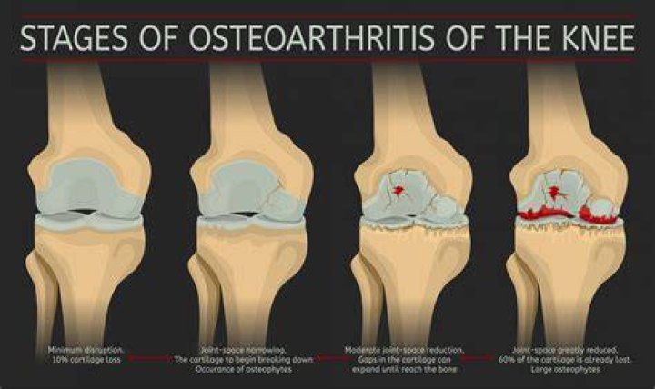 What is end stage of osteoarthritis?