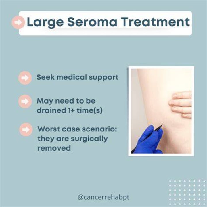 When do seroma stop filling?