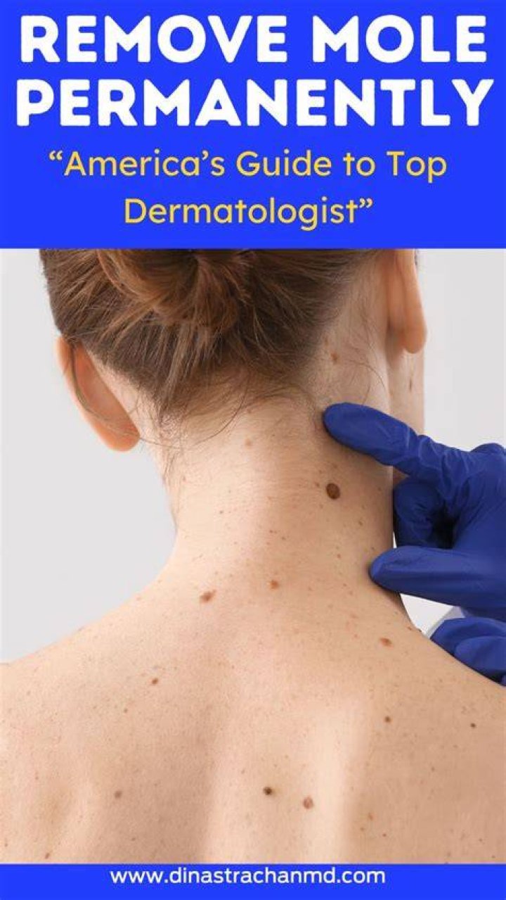 Why would a dermatologist remove a mole?